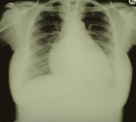 lv lift|left ventricular hypertrophy x ray.